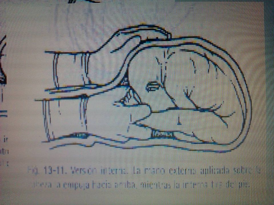 Maniobras internas, la mano en el interior del útero con dilatación completa. La mano externa ayuda desde el abdomen. Es imprescindible que la bolsa esté íntegra o se haya roto poco antes para que no se retraiga el útero sobre el feto. Requiere anestesia para conseguir una buena relajación. Trata de colocar las nalgas fetales en la pelvis materna, traccionando sobre los miembros inferiores del feto. La versión de Braxton-Hicks sirve para solucionar la hemorragia de una placenta previa. Requiere la introducción de dos dedos para coger un pie fetal y bajarlo a la vagina para que las nalgas compriman la placenta.