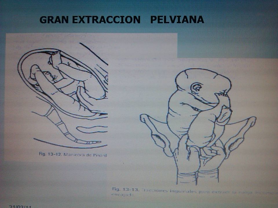 Consiste en extraer el feto manualmente cuando se encuentra en presentación de nalgas haciendo presa en sus miembros inferiores, cuando éstos están bastantes descendidos y hay dilatación completa.
