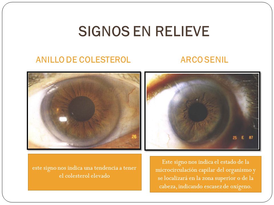 este signo nos indica una tendencia a tener el colesterol elevado