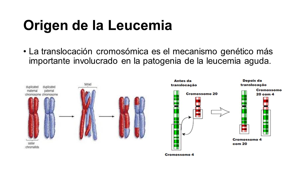 Origen de la Leucemia La translocación cromosómica es el mecanismo genético más importante involucrado en la patogenia de la leucemia aguda.