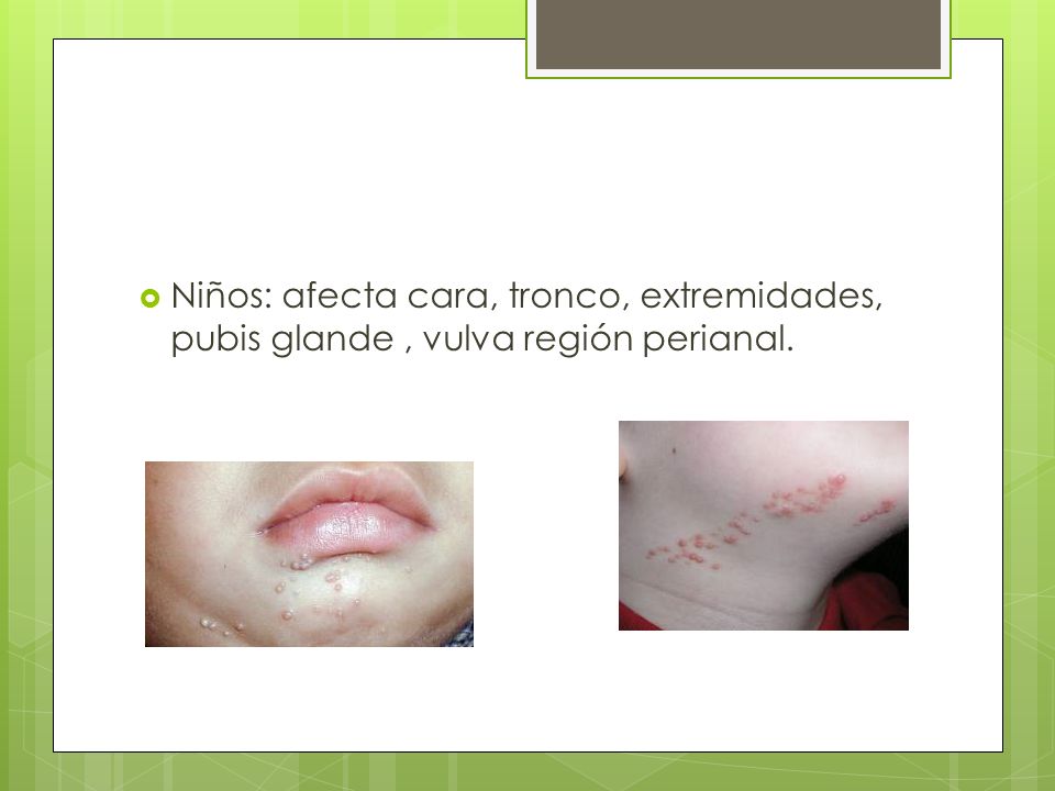Niños: afecta cara, tronco, extremidades, pubis glande , vulva región perianal.