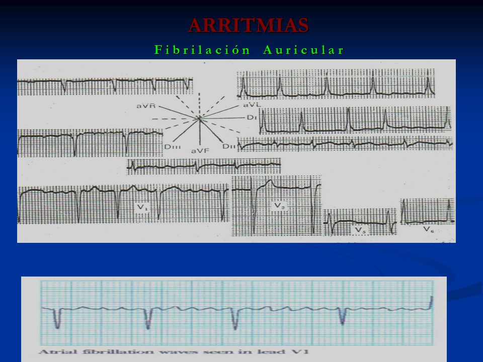 ARRITMIAS F i b r i l a c i ó n A u r i c u l a r