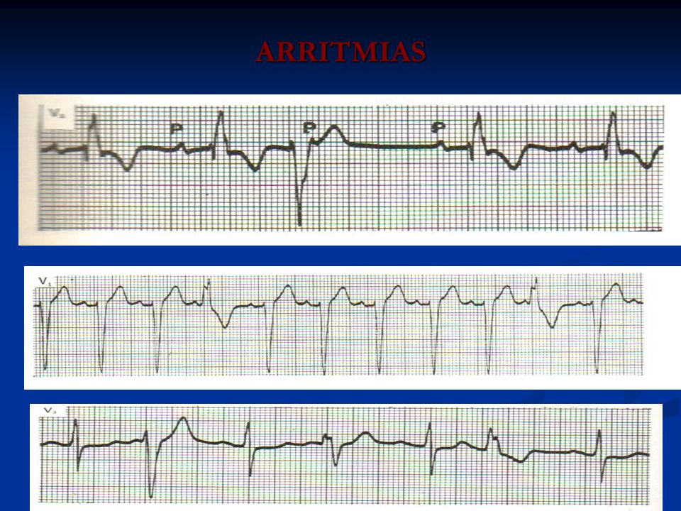 ARRITMIAS