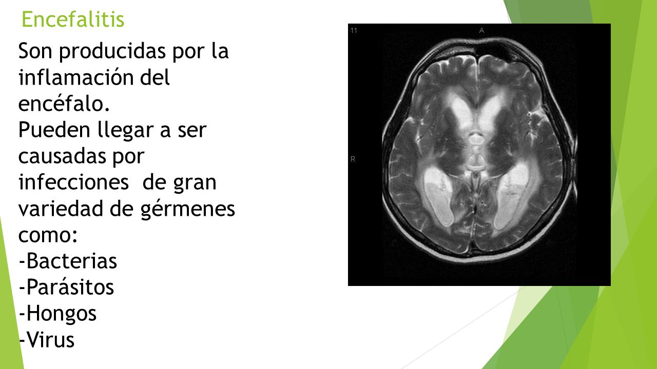 Encefalitis Son producidas por la inflamación del encéfalo. Pueden llegar a ser causadas por infecciones de gran variedad de gérmenes como: