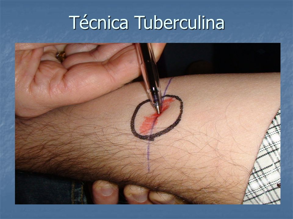 Técnica Tuberculina