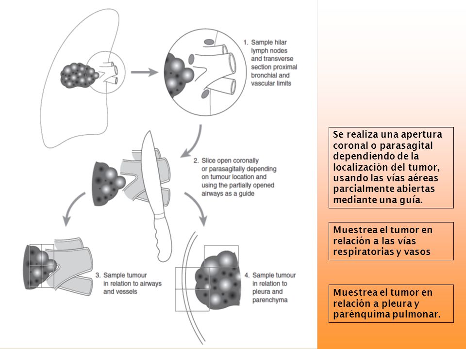 Se realiza una apertura coronal o parasagital dependiendo de la localización del tumor, usando las vías aéreas parcialmente abiertas mediante una guía.