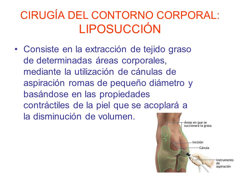 CIRUGÍA DEL CONTORNO CORPORAL: LIPOSUCCIÓN