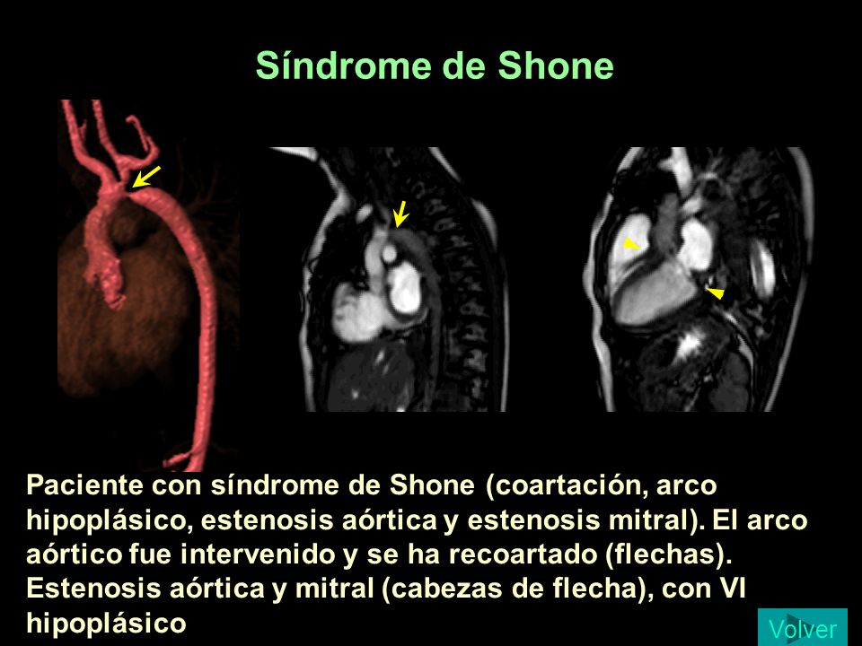 Síndrome de Shone Collado 11m SD Shone Qx con recoartacion.