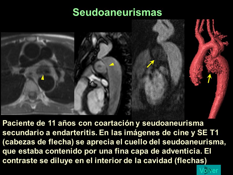Seudoaneurismas Lopez Florez 11 a, coartacion seudoaneurisma por endarteritis.