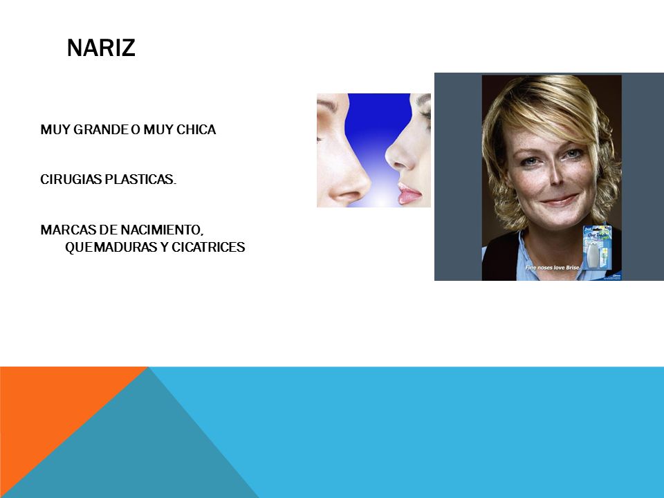 NARIZ MUY GRANDE O MUY CHICA CIRUGIAS PLASTICAS. MARCAS DE NACIMIENTO, QUEMADURAS Y CICATRICES