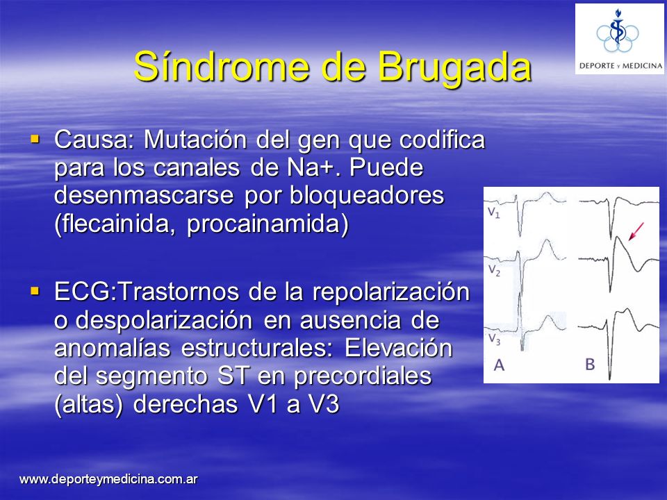 Síndrome de Brugada Causa: Mutación del gen que codifica para los canales de Na+. Puede desenmascarse por bloqueadores (flecainida, procainamida)