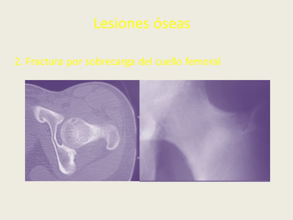 Lesiones óseas 2. Fractura por sobrecarga del cuello femoral
