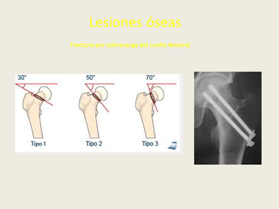 Lesiones óseas Fractura por sobrecarga del cuello femoral