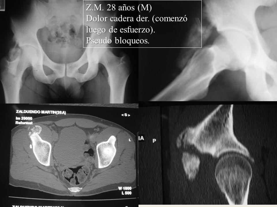 Z.M. 28 años (M) Dolor cadera der. (comenzó luego de esfuerzo). Pseudo bloqueos.