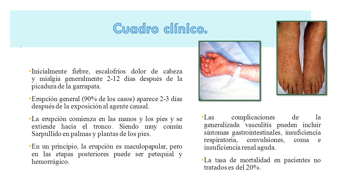 Cuadro clínico. Jose. Inicialmente fiebre, escalofríos dolor de cabeza y mialgia generalmente 2-12 días después de la picadura de la garrapata.