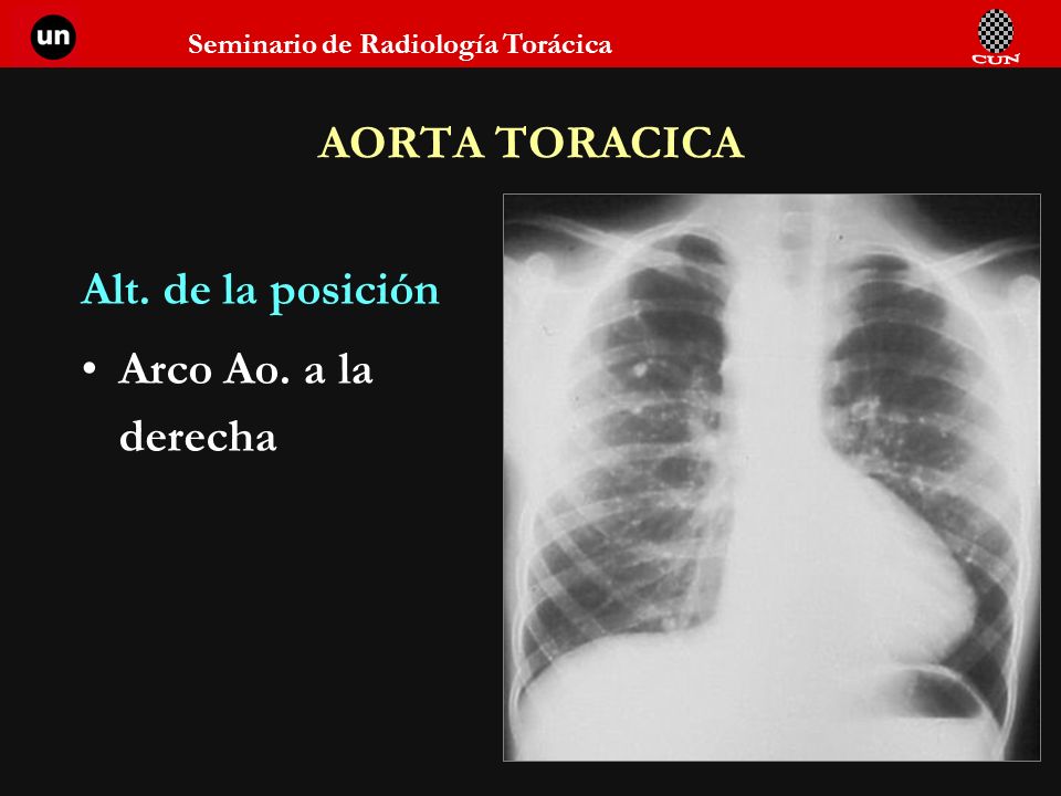 AORTA TORACICA Alt. de la posición Arco Ao. a la derecha