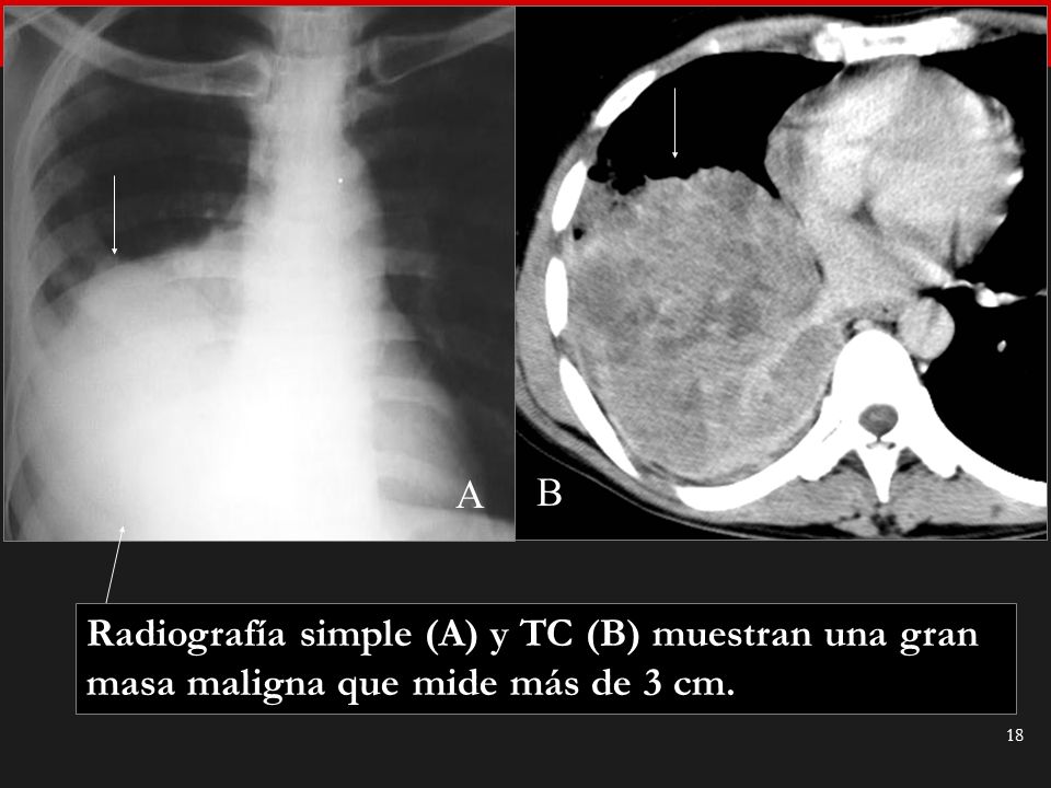 A B Radiografía simple (A) y TC (B) muestran una gran masa maligna que mide más de 3 cm.