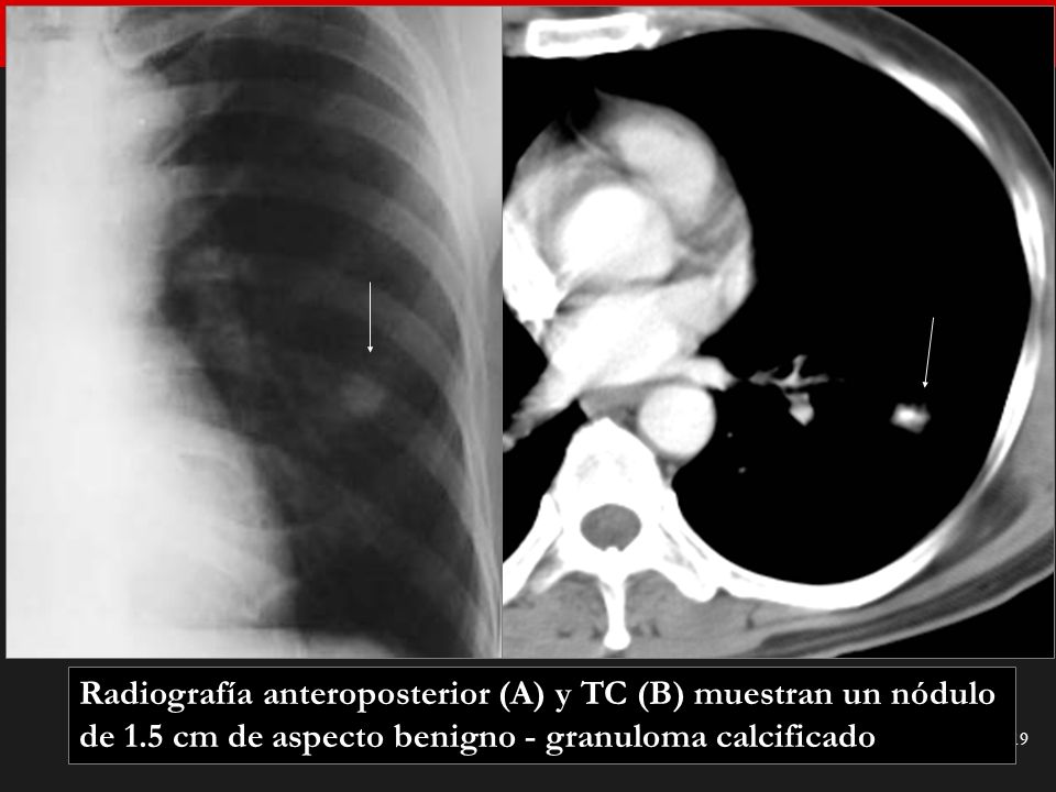 Radiografía anteroposterior (A) y TC (B) muestran un nódulo de 1