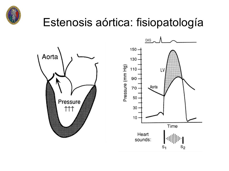 Estenosis aórtica: fisiopatología