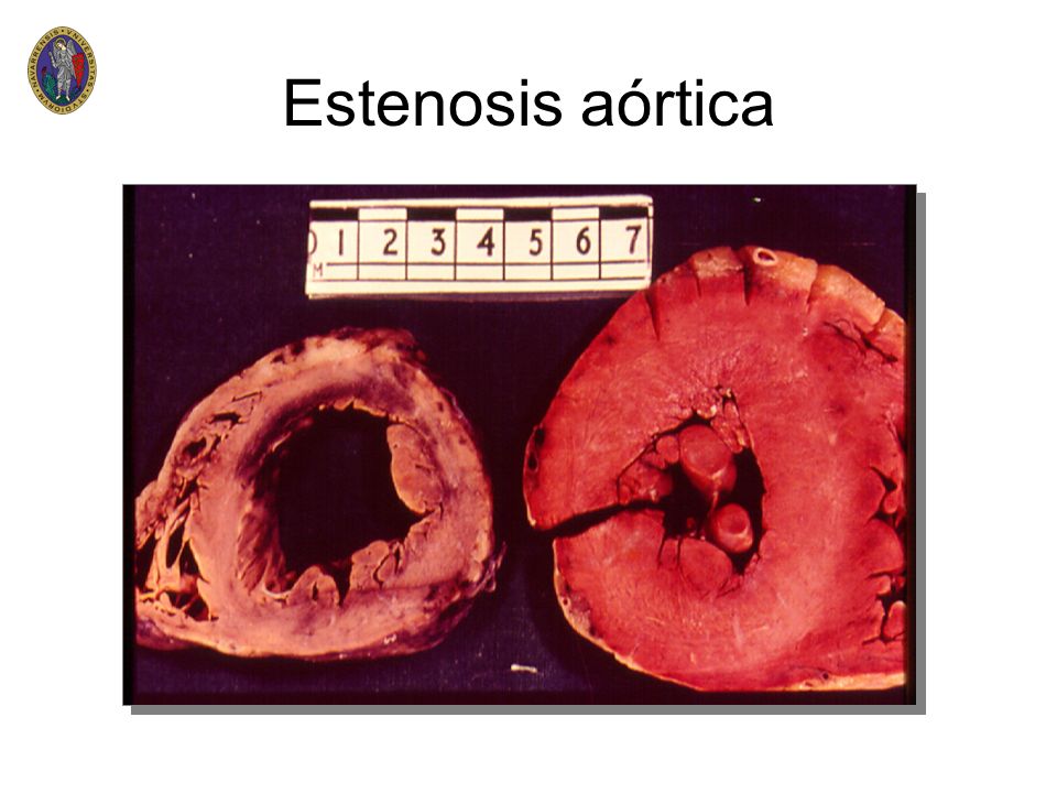Estenosis aórtica