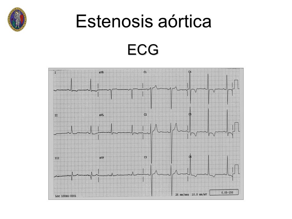 Estenosis aórtica ECG