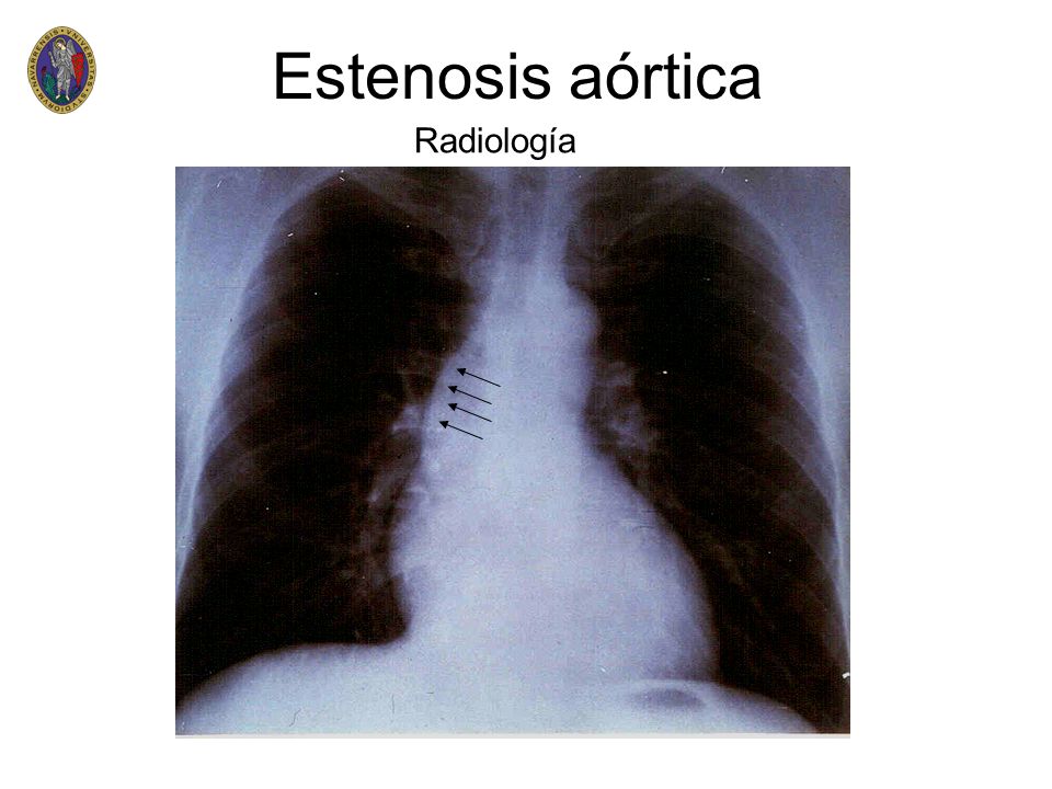 Estenosis aórtica Radiología