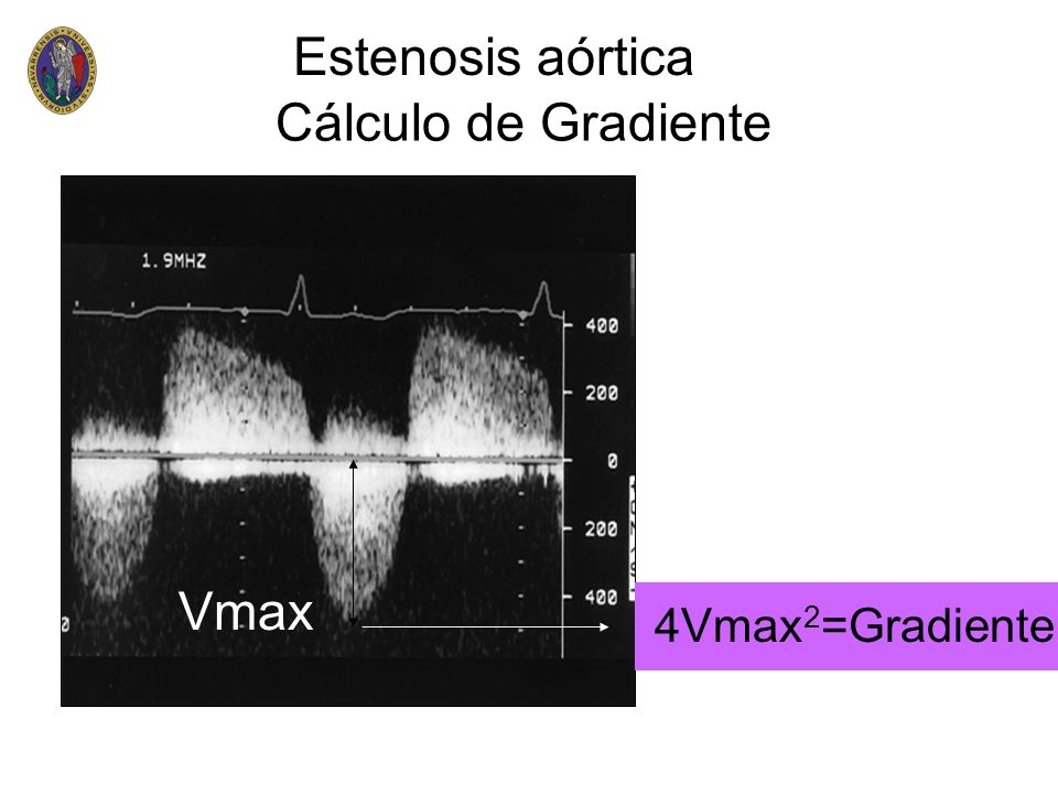 Estenosis aórtica Cálculo de Gradiente Vmax 4Vmax2=Gradiente