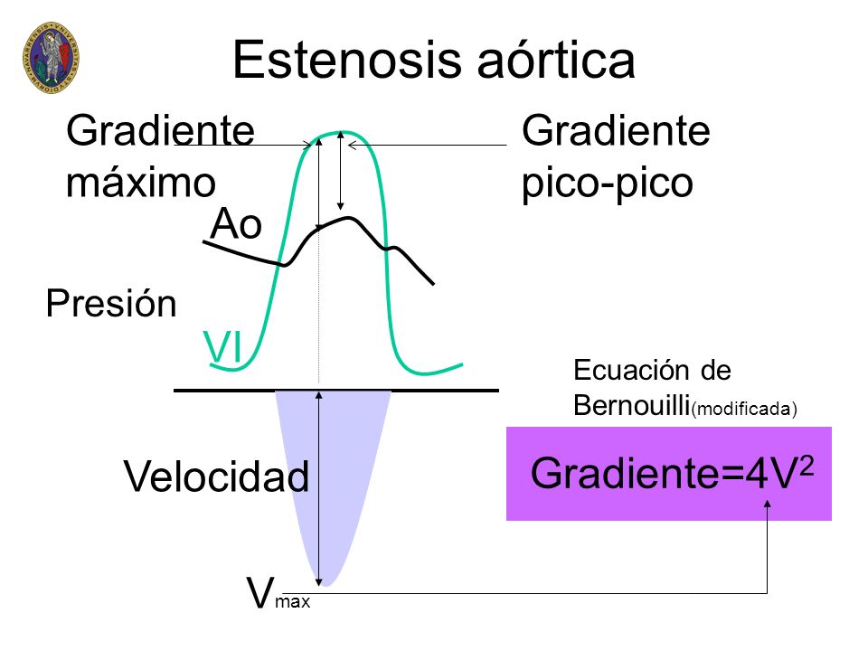 Estenosis aórtica Gradiente máximo Gradiente pico-pico Ao VI Velocidad