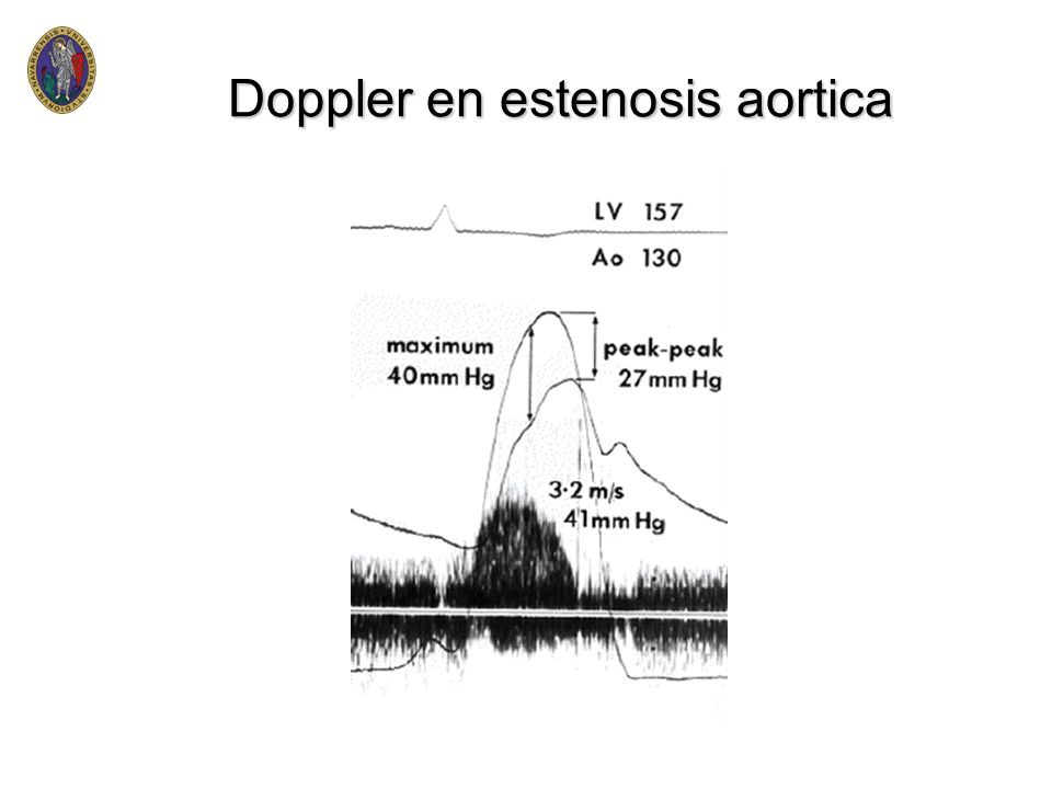 Doppler en estenosis aortica
