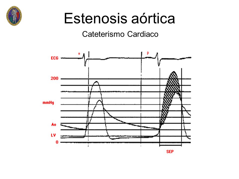 Estenosis aórtica Cateterismo Cardiaco