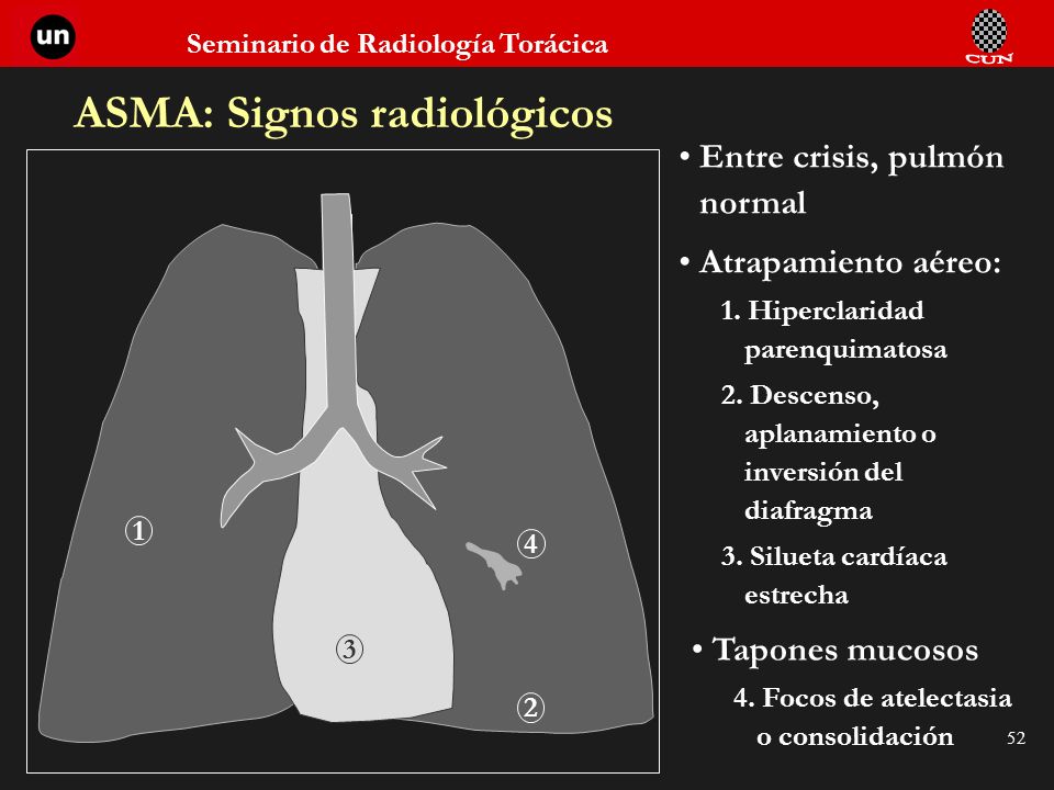 ASMA: Signos radiológicos