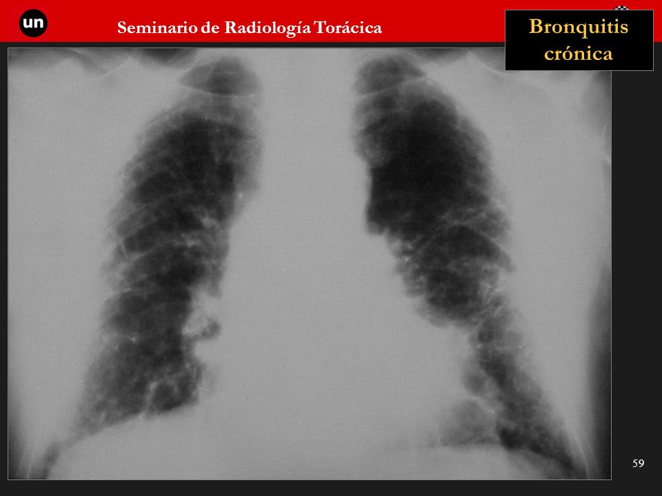 Bronquitis crónica