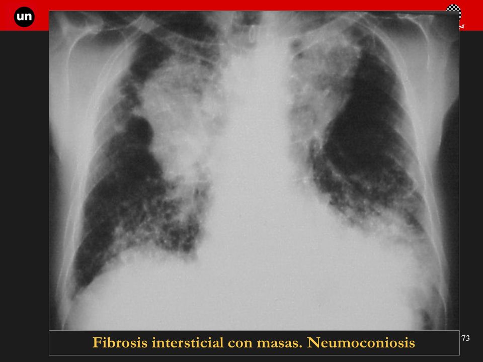 Fibrosis intersticial con masas. Neumoconiosis