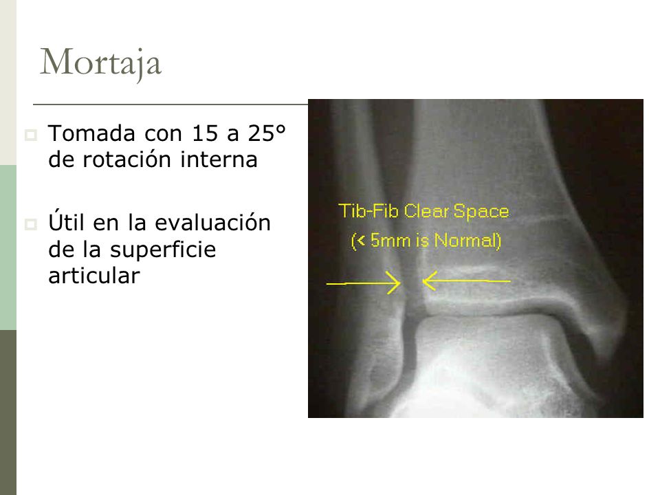 Mortaja Tomada con 15 a 25° de rotación interna