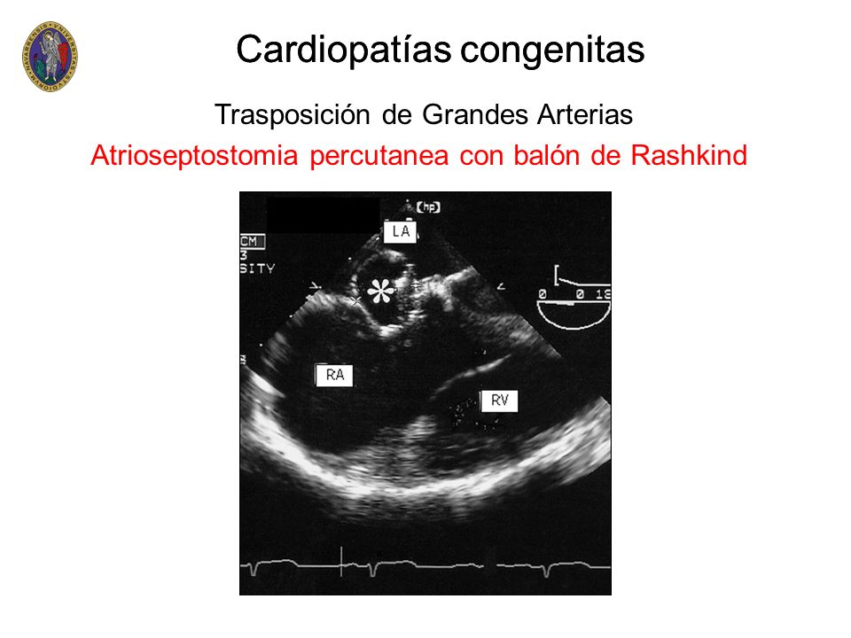 Cardiopatías congenitas Cardiopatías congenitas