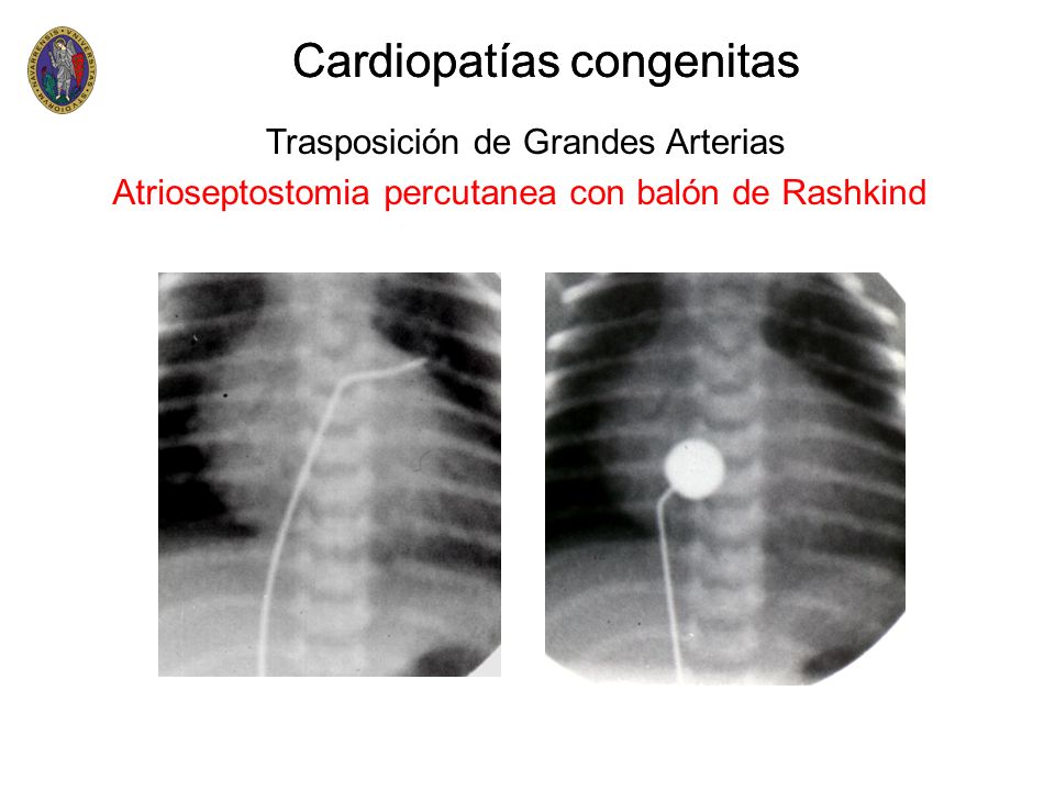 Cardiopatías congenitas Cardiopatías congenitas