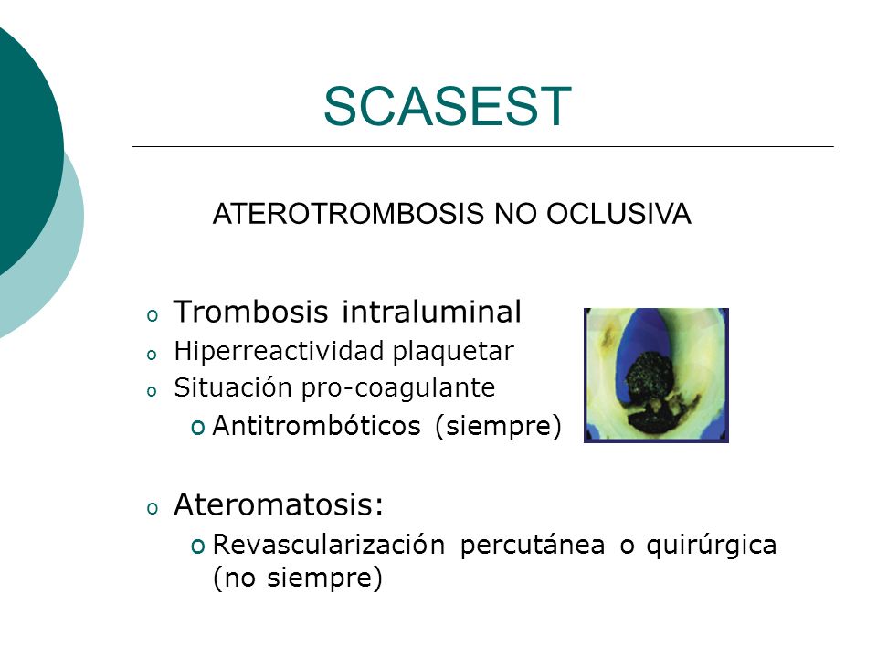 SCASEST Trombosis intraluminal Ateromatosis: