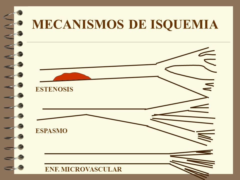 MECANISMOS DE ISQUEMIA