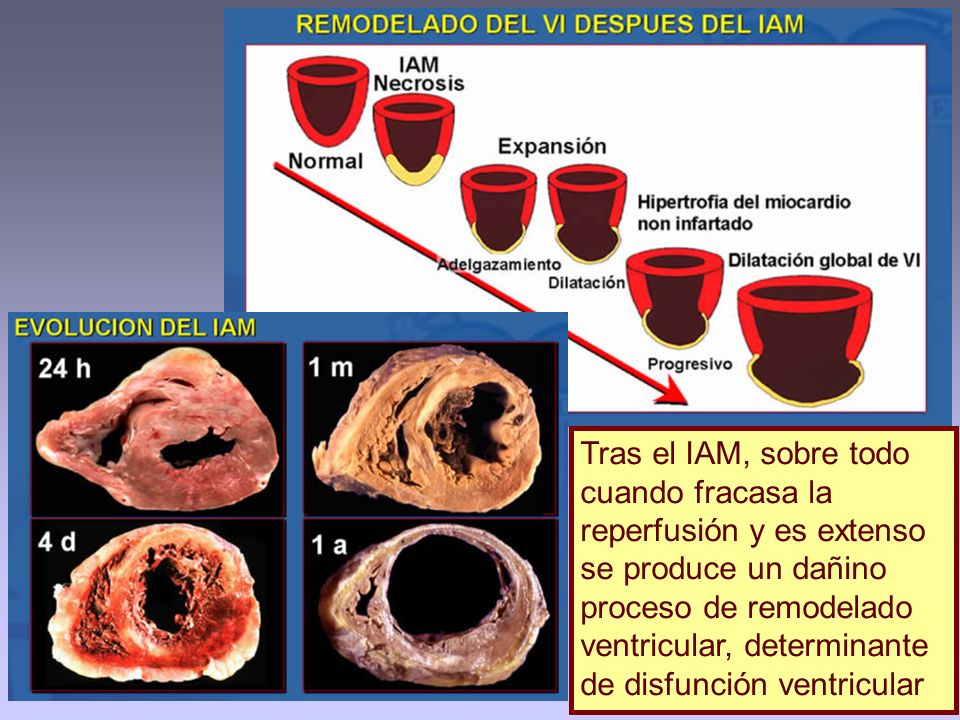 Tras el IAM, sobre todo cuando fracasa la reperfusión y es extenso se produce un dañino proceso de remodelado ventricular, determinante de disfunción ventricular
