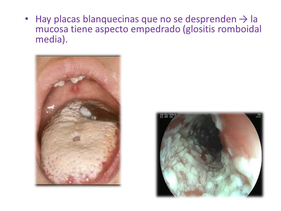 Hay placas blanquecinas que no se desprenden → la mucosa tiene aspecto empedrado (glositis romboidal media).