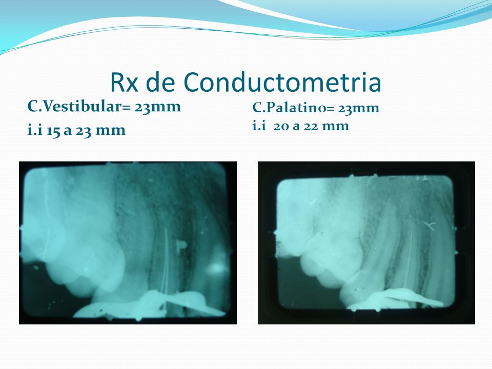 Rx de Conductometria C.Vestibular= 23mm i.i 15 a 23 mm