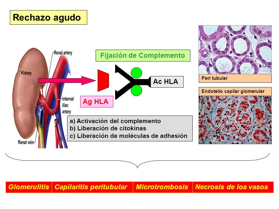 Rechazo agudo Fijación de Complemento Ac HLA Ag HLA Glomerulitis