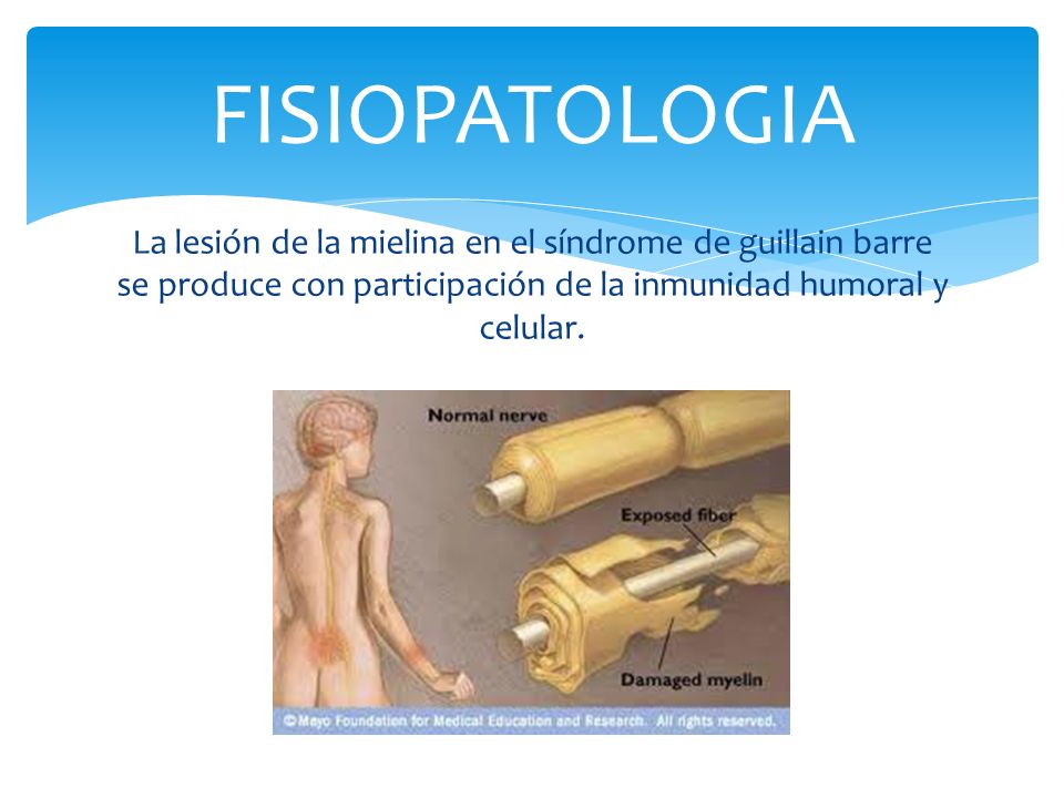 FISIOPATOLOGIA La lesión de la mielina en el síndrome de guillain barre se produce con participación de la inmunidad humoral y celular.