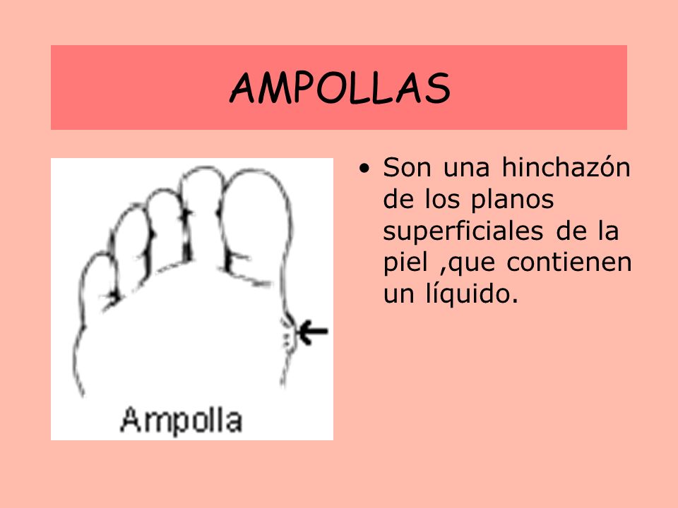 AMPOLLAS Son una hinchazón de los planos superficiales de la piel ,que contienen un líquido.