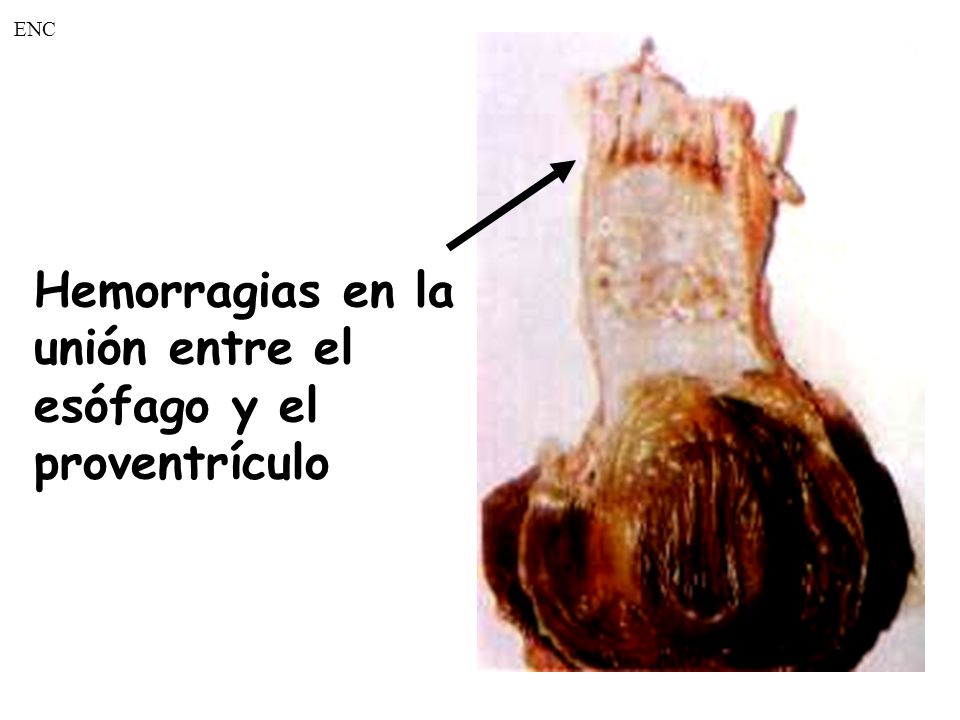 ENC Hemorragias en la. unión entre el. esófago y el.