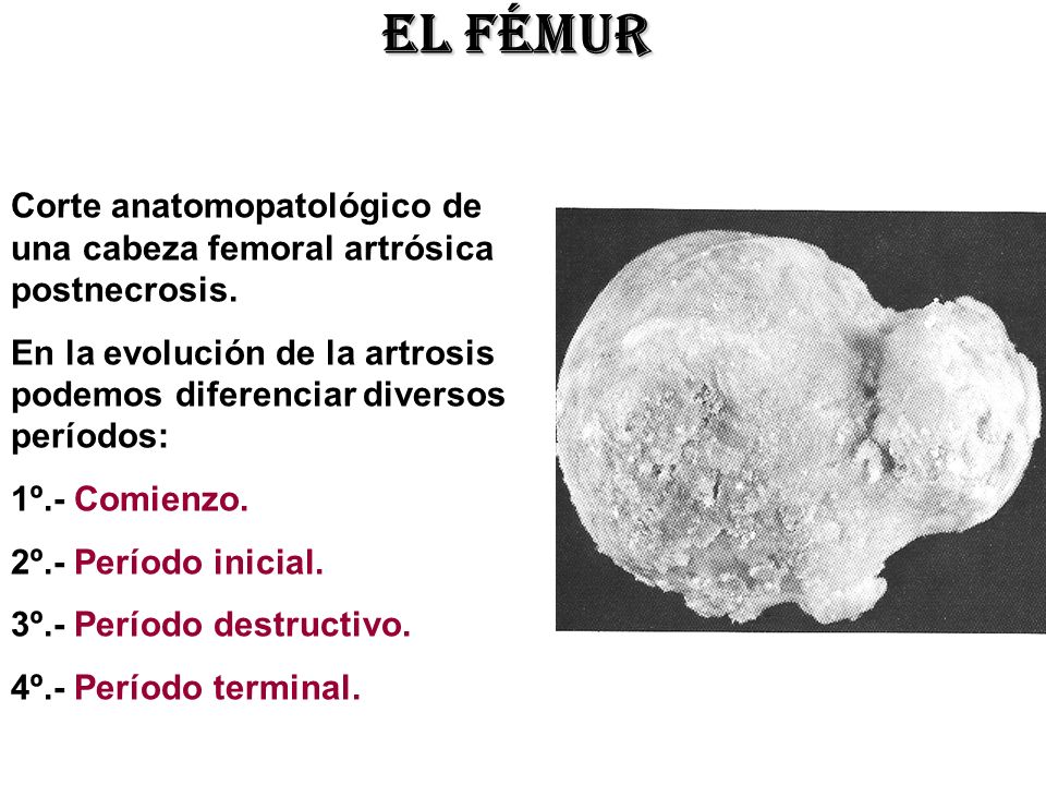 El fémur Corte anatomopatológico de una cabeza femoral artrósica postnecrosis. En la evolución de la artrosis podemos diferenciar diversos períodos: