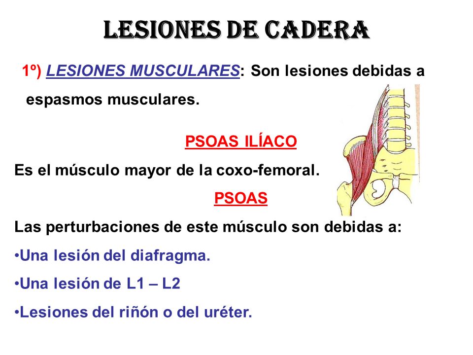 Lesiones de cadera 1º) LESIONES MUSCULARES: Son lesiones debidas a