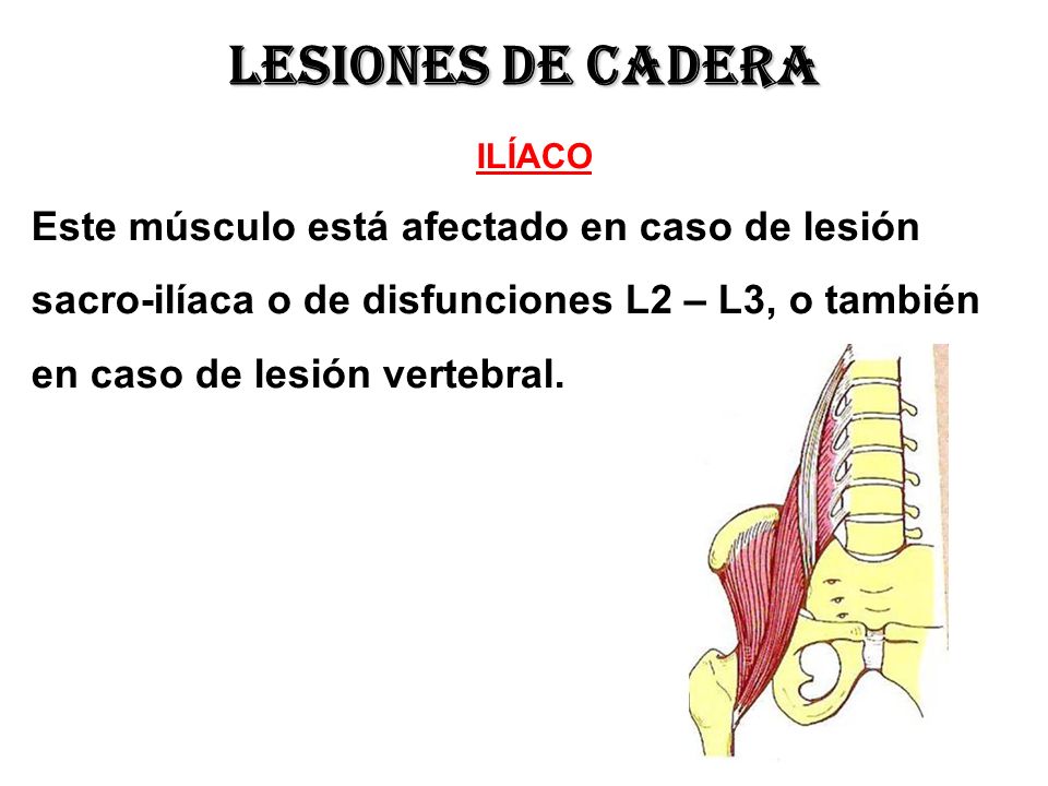 Lesiones de cadera Este músculo está afectado en caso de lesión