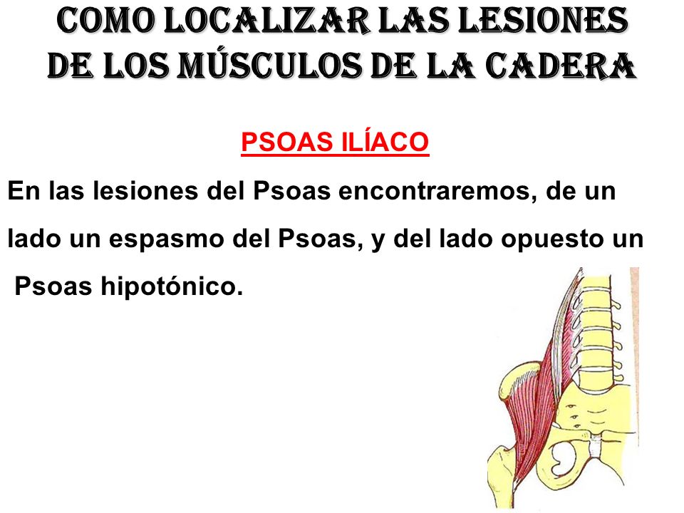 Como localizar las lesiones de los músculos de la cadera