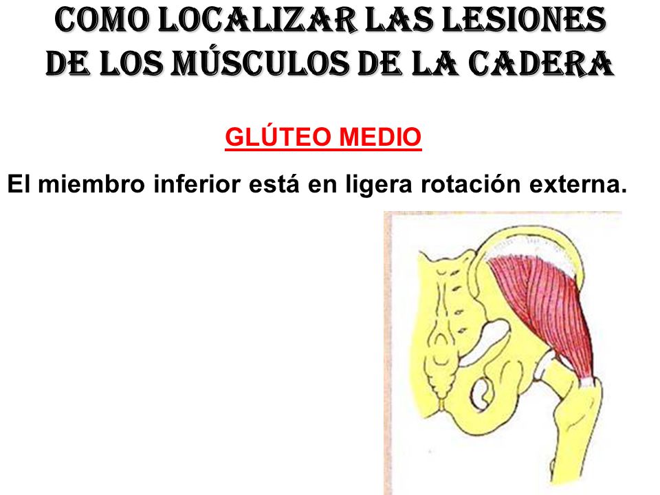 Como localizar las lesiones de los músculos de la cadera